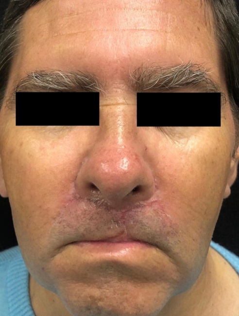 45 dias de p&oacute;s-operat&oacute;rio