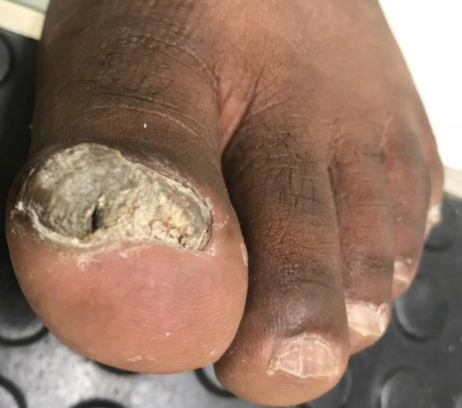 Onicodistrofia do h&aacute;lux esquerdo