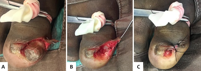 Bi&oacute;psia excisional do onicomatricoma do h&aacute;lux esquerdo: a) tumor
								visto no intraoperat&oacute;rio, b) retirada da les&atilde;o, c) fechamento ap&oacute;s
								explora&ccedil;&atilde;o cir&uacute;rgica