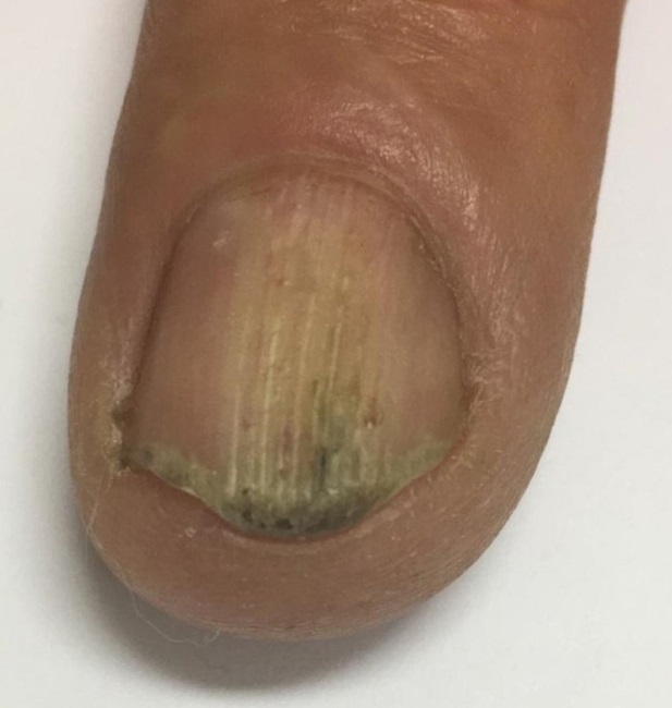 Observam-se hiperceratose subungueal e hipercurvatura
								longitudinal da placa da unha do terceiro quirod&aacute;ctilo
								direito