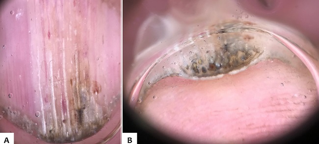 Dermatoscopia: a) identificam-se xanton&iacute;quia, hemorragias em
								estilha&ccedil;o, b) hiperceratose subungueal, hipercurvatura longitudinal
								da placa ungueal e cavita&ccedil;&otilde;es do terceiro quirod&aacute;ctilo
								direito