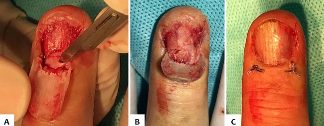 Bi&oacute;psia excisional do terceiro quirod&aacute;ctilo direito: a) retirada
								do onicomatricoma, b) visualiza&ccedil;&atilde;o do tumor intraoperat&oacute;rio, c)
								fechamento ap&oacute;s procedimento cir&uacute;rgico