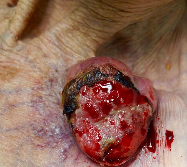 Grande tumoração violacea, ulcerada na região clavicular
							esquerda