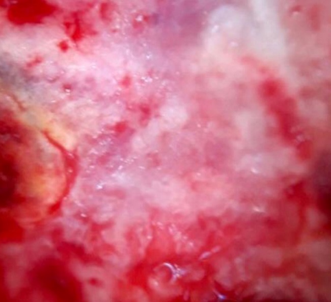 Dermatoscopia: vasos polimórficos