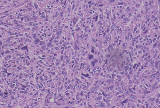 Neoplasia com predomínio de celulas fusiformes com nucleos de
							tamanhos variados e cromatina irregular