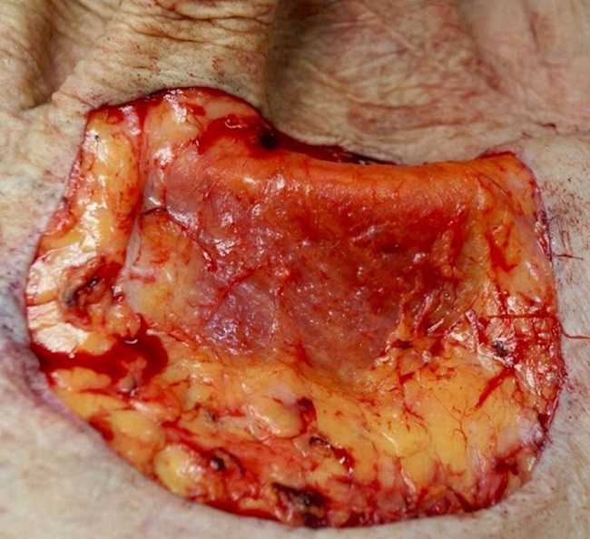 Ferida após a exérese