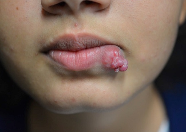 Nodosidade erit&ecirc;mato-viol&aacute;cea, de superficie mamilonada e
							consist&ecirc;ncia fibroel&aacute;stica