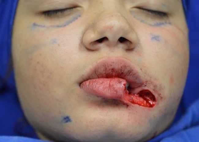 Prolifera&ccedil;&atilde;o mesenguimal fusocelular fibromixoide