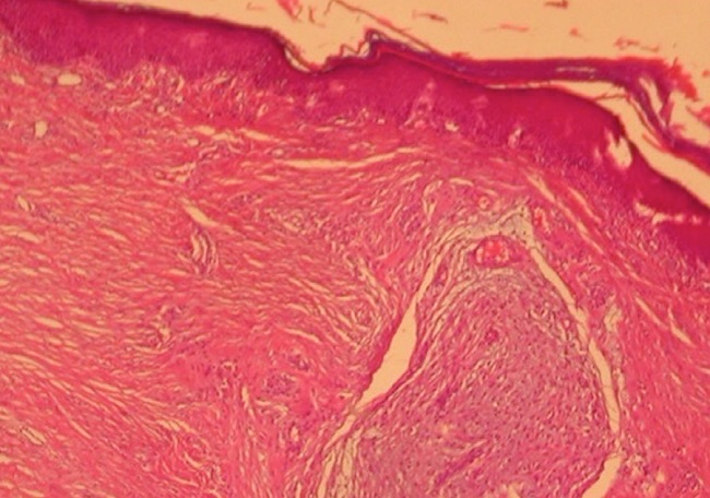 Defeito cir&uacute;rgico ap&oacute;s excis&atilde;o com controle de margens operat&oacute;rias.
							Realizada sutura com aproximacao primaria das bordas aproxima&ccedil;&atilde;o
							prim&aacute;ria