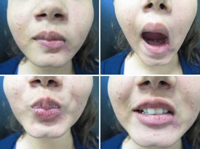 Paciente avaliada ap&oacute;s 1 ano do procedimento com bom resultado
							funcional