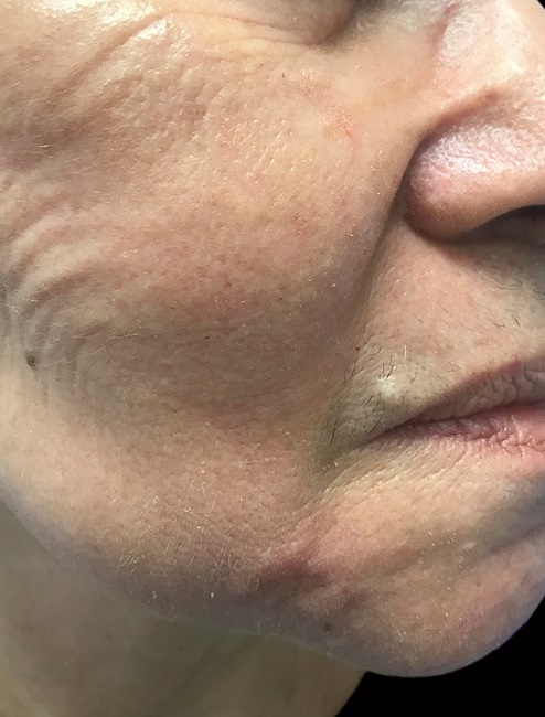 12&ordm; dia de p&oacute;soperat&oacute;rio: n&oacute;dulo firme