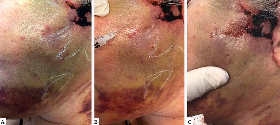 A - 12&ordm; dia de p&oacute;s-operat&oacute;rio: hematoma com
								pregueamento da pele e sofrimento do retalho; B -
								Inje&ccedil;&atilde;o de hialuronidase para dissolver o hematoma consolidado;
									C - Sangue drenado