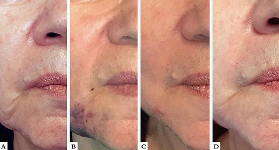 A - Antes da subcis&atilde;o B - 7&ordm; dia de
								p&oacute;soperat&oacute;rio: equimose local e hematoma C - 12&ordm; dia de
								p&oacute;soperat&oacute;rio: n&oacute;dulo firme D- Resultado final ap&oacute;s
								seis semanas da drenagem