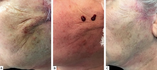 A - Duas semanas ap&oacute;s, &aacute;reas azuladas e endurecidas;
									B - Drenagem de sangue vermelho vinhoso ap&oacute;s
								puntura com agulha 22G; C - Resultado final