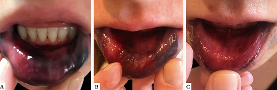 A - Hematoma bilateral do l&aacute;bio inferior, formado
								ap&oacute;s inje&ccedil;&atilde;o de hialuronidase com agulha; B - Uma hora
								ap&oacute;s a inje&ccedil;&atilde;o de hialuronidase com c&acirc;nula para absor&ccedil;&atilde;o do
								hematoma; C - 24 horas ap&oacute;s inje&ccedil;&atilde;o de hialuronidase,
								mostrando clareamento quase total do hematoma do l&aacute;bio
								inferior