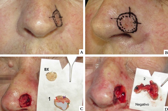 A e B - Les&atilde;o demarcada com aux&iacute;lio dermatosc&oacute;pico em asa nasal esquerda. Marca&ccedil;&atilde;o de margem de 2mm e nicks. C - Defeito cir&uacute;rgico ap&oacute;s remo&ccedil;&atilde;o da pe&ccedil;a com margem ex&iacute;gua no primeiro est&aacute;gio, apresentando tumor residual. D - Defeito cir&uacute;rgico final, de espessura total, com margens livres no segundo est&aacute;gio cir&uacute;rgico