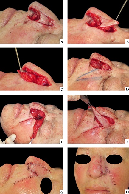 A - Incis&atilde;o do tri&acirc;ngulo de Burrow, superiormente ao defeito cir&uacute;rgico, em &aacute;rea que seria desprezada com a movimenta&ccedil;&atilde;o do retalho de transposi&ccedil;&atilde;o do sulco nasogeniano. B - Descolamento do tri&acirc;ngulo, mantendo ped&iacute;culo profundo distal. C - Tri&acirc;ngulo rebatido em dobradi&ccedil;a para formar o assoalho nasal. D - Ap&oacute;s posicionamento do tri&acirc;ngulo e sutura dos tecidos adjacentes, o retalho de transposi&ccedil;&atilde;o do sulco nasogeniano &eacute; programado. E - O retalho &eacute; incisado acompanhando o sulco nasogeniano. Ap&oacute;s liberado dos planos profundos, &eacute; realizado o fechamento do defeito secund&aacute;rio por planos de sutura. F - Movimento de transposi&ccedil;&atilde;o do retalho sobre o assoalho nasal, criado a partir do retalho em dobradi&ccedil;a. G - Ap&oacute;s sutura dos tecidos adjacentes, &eacute; feita corre&ccedil;&atilde;o do comprimento dos retalhos e, ao n&iacute;vel da margem nasal, suas por&ccedil;&otilde;es distais foram suturadas borda a borda. H - P&oacute;s-operat&oacute;rio imediato