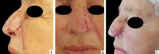 A e B - Aspecto cl&iacute;nico no s&eacute;timo dia de p&oacute;s-operat&oacute;rio, com retirada dos pontos. C - Aspecto cl&iacute;nico na quarta semana de p&oacute;s-operat&oacute;rio