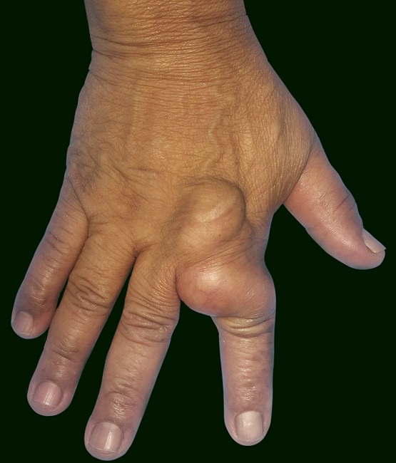 Tumefa&ccedil;&atilde;o na face dorsal da m&atilde;o direita estendendo-se para a falange proximal do dedo indicador