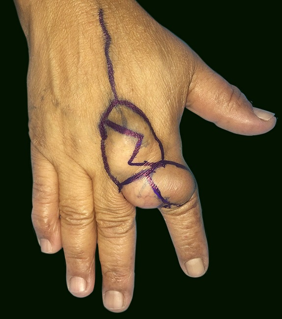 Marca&ccedil;&atilde;o da abordagem cir&uacute;rgica modificada de Bruner