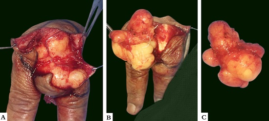 A, B e C - Imagens intraoperat&oacute;rias do lipoma gigante no dorso da m&atilde;o