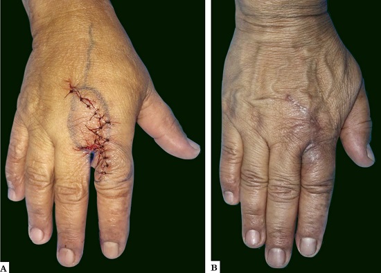 A - Imagens do p&oacute;s-operat&oacute;rio imediato e B - ap&oacute;s quatro meses