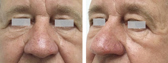 Paciente 1. Carcinoma basocelular na ponta nasal do lado esquerdo, perto da asa nasal