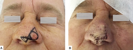 Paciente 1. A - Demarca&ccedil;&atilde;o do tumor e desenho do retalho lesteoeste. B - Resultados imediatos ap&oacute;s A B a cirurgia