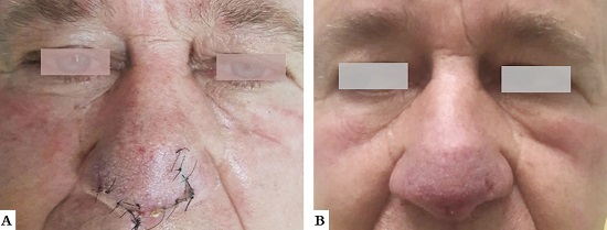 Paciente 1. A - Resultados depois de uma semana da cirurgia com as suturas. B - Sem as suturas