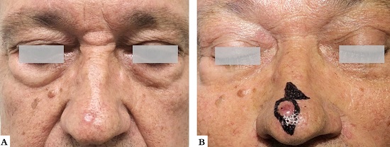 Paciente 2. A - Carcinoma basocelular na ponta nasal. B - Demarca&ccedil;&atilde;o do tumor e desenho do retalho leste-oeste modificado