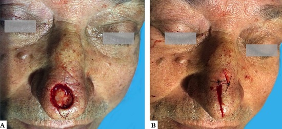 Paciente 2. A - Defeito ap&oacute;s ex&eacute;rese do tumor. B - Pontos-chave para aproximar o retalho