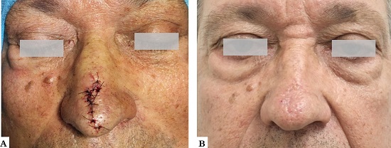 Paciente 2. A - Resultados imediatos ap&oacute;s a cirurgia. B - Depois de tr&ecirc;s meses de acompanhamento