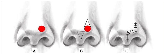 A - Defeito na ponta nasal. B - Desenho do retalho lesteoeste, com um tri&acirc;ngulo de Burrow (superior) sobre o defeito cir&uacute;rgico e um segundo tri&acirc;ngulo (inferior) na linha m&eacute;dia nasal, no meio da columela. C - Fechamento com as suturas
