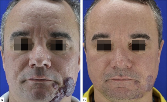 A - Paciente 5, do g&ecirc;nero masculino, 43 anos, apresentando hemangioma em regi&atilde;o mandibular esquerda. 
						B - Importante redu&ccedil;&atilde;o da tumora&ccedil;&atilde;o e atenua&ccedil;&atilde;o da tonalidade ap&oacute;s tratamento
					