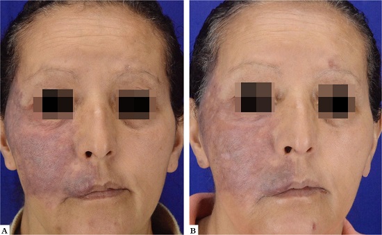 A - Paciente 6, g&ecirc;nero feminino, 53 anos, apresentando mancha em vinho do Porto em hemiface direita. 
							B - Redu&ccedil;&atilde;o homog&ecirc;nea da tonalidade e redu&ccedil;&atilde;o volum&eacute;trica de les&atilde;o labial ap&oacute;s terapia combinada
						