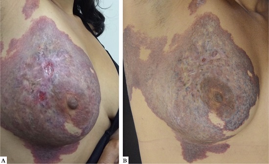 A - Paciente 7, g&ecirc;nero feminino, 27 anos, apresentando hemangioma extenso em regi&atilde;o mam&aacute;ria direita, com algumas ulcera&ccedil;&otilde;es e cicatrizes atr&oacute;ficas. 
								B - Homogeneiza&ccedil;&atilde;o da tonalidade e redu&ccedil;&atilde;o da espessura ap&oacute;s tratamento
							