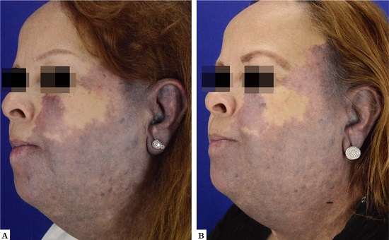 A - Paciente 8, g&ecirc;nero feminino, 50 anos, apresentando hemangioma de grandes propor&ccedil;&otilde;es em hemiface esquerda e cervical lateral esquerda. 
									B - Atenua&ccedil;&atilde;o da textura e leve melhora da tonalidade ap&oacute;s nove sess&otilde;es
								
