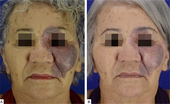A - Paciente 9, g&ecirc;nero feminino, 69 anos, apresentando hemangioma em hemiface esquerda. 
										B - P&oacute;s-procedimento com terapia combinada demonstrando efetiva melhora da tonalidade e redu&ccedil;&atilde;o da espessura
									