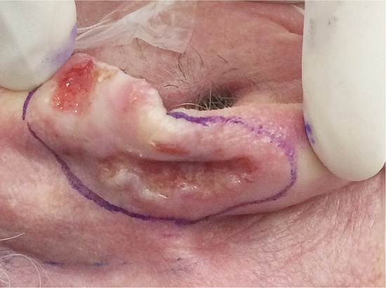 Avalia&ccedil;&atilde;o pr&eacute;-operat&oacute;ria e demarca&ccedil;&atilde;o da margem de seguran&ccedil;a