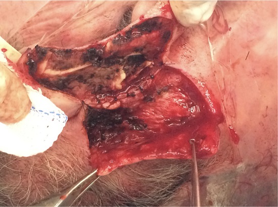 Ressec&ccedil;&atilde;o da les&atilde;o, incluindo toda a espessura da pele, o peric&ocirc;ndrio e a cartilagem acometida. Eleva&ccedil;&atilde;o do retalho retroauricular e s&iacute;ntese da ilha de pele no sulco retroauricular