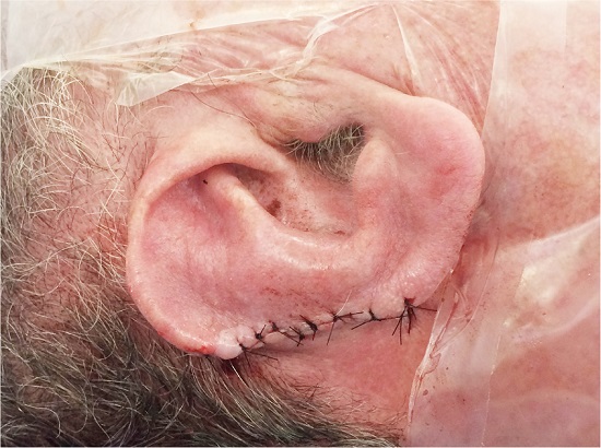 Sutura do retalho de interpola&ccedil;&atilde;o na &aacute;rea cruenta da borda lateral da h&eacute;lice da orelha