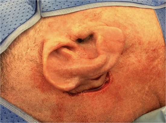 Reabordagem ap&oacute;s 21 dias e libera&ccedil;&atilde;o do ped&iacute;culo