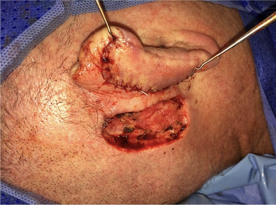 Fechamento completo do defeito prim&aacute;rio e exposi&ccedil;&atilde;o da &aacute;rea doadora