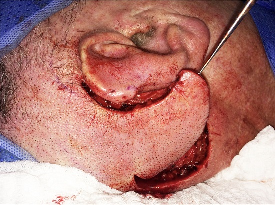 Retalho de rota&ccedil;&atilde;o para fechamento da &aacute;rea doadora