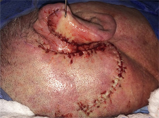 Aspecto imediato da reconstru&ccedil;&atilde;o