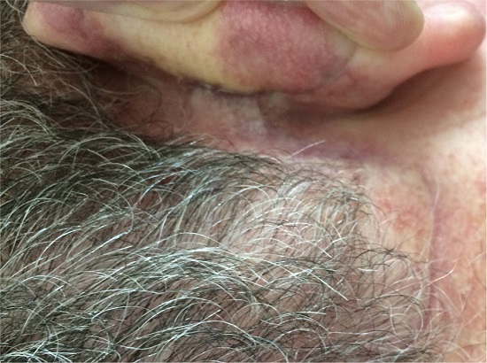 Aspecto tardio da reconstru&ccedil;&atilde;o