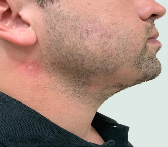 Área alopécica em barba lado direito