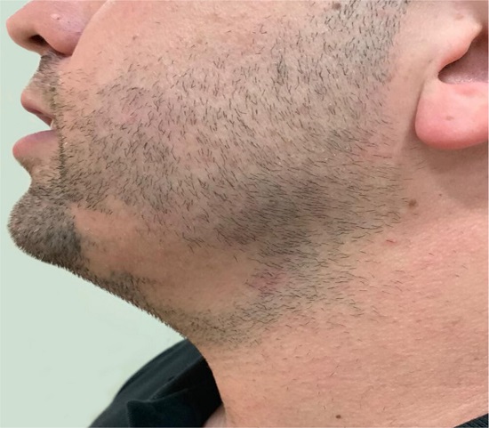 Área alopécica em barba lado