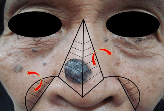 Demarca&ccedil;&atilde;o da incis&atilde;o