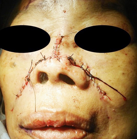 Sutura posicionada na linha m&eacute;dia, sulco alar e sulco nasolabial de
							ambos os lados do defeito